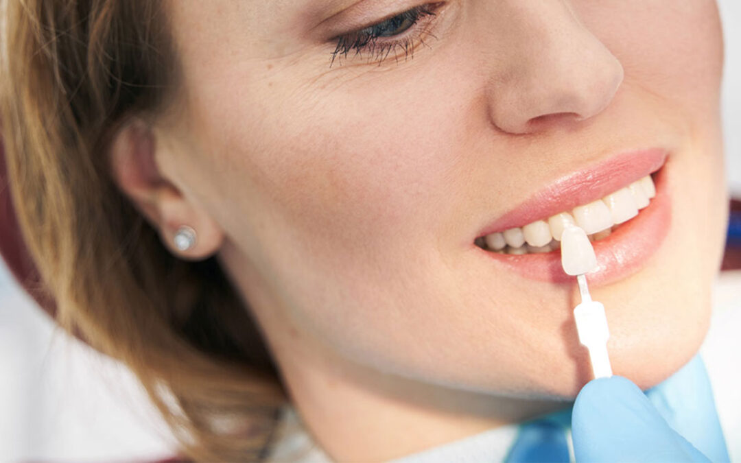 Wie lange halten Veneers auf den Zähnen?