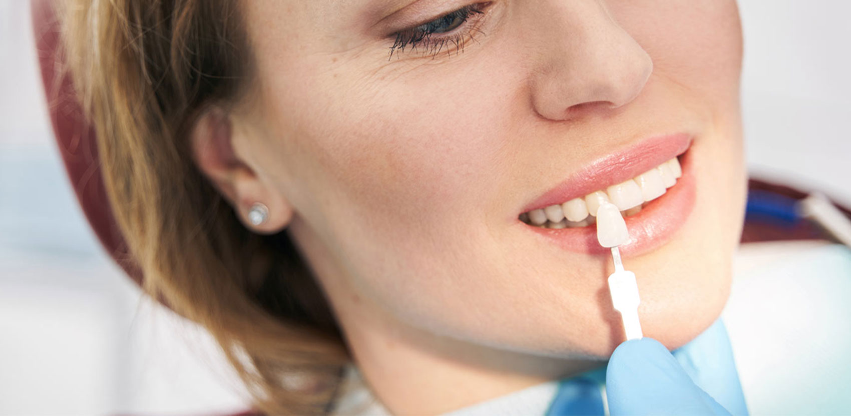 Wie lange halten Veneers auf den Zähnen?<br />
